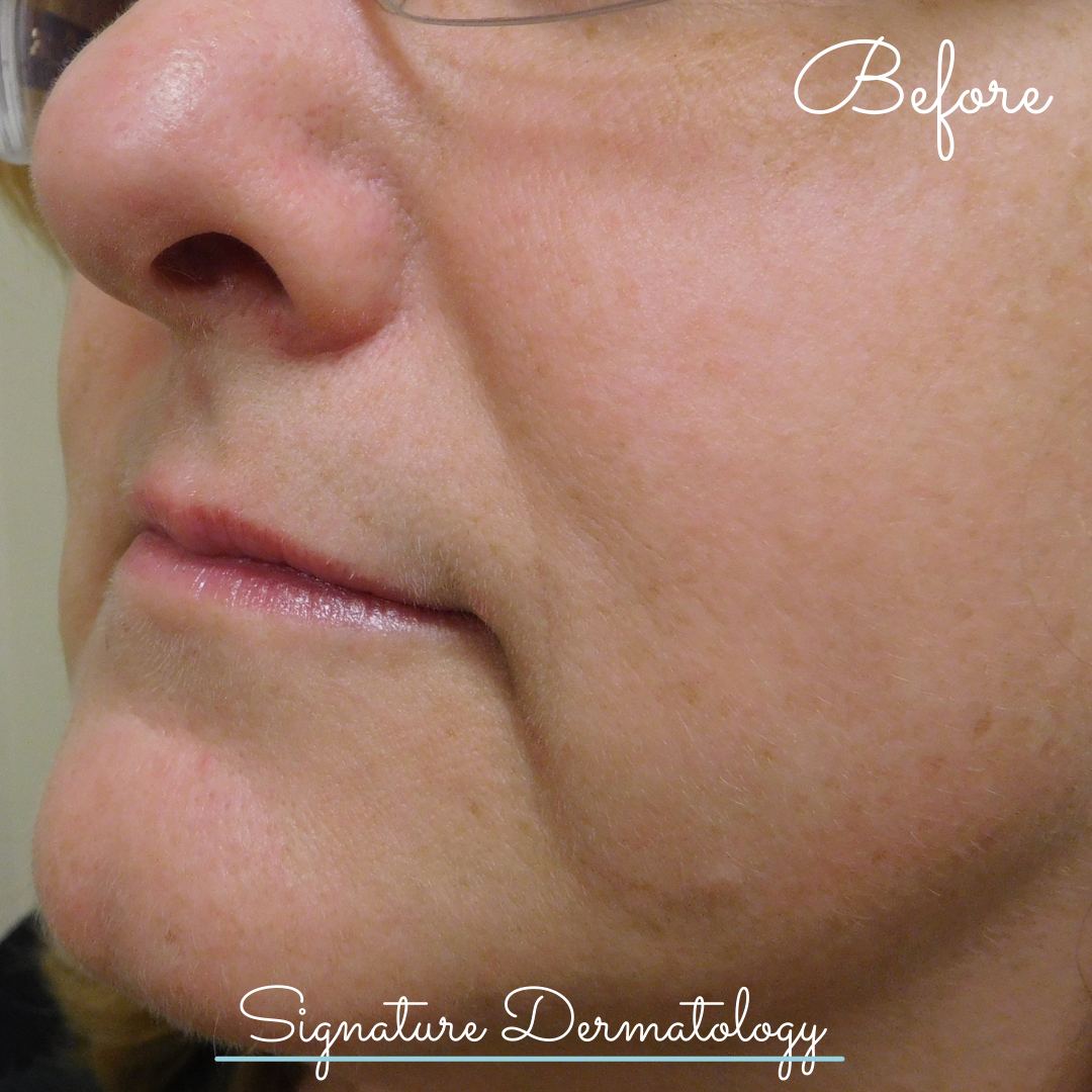 Marionette Lines Before and After | Signature Dermatology